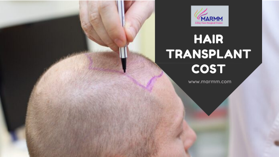 Hair transplant cost in Indore